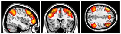 Impacts of urban green infrastructure on attentional functioning: insights from an fMRI study